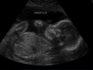 Ultra Sound Baby Womb North Strand Ultra Sound Myrtle Beach
